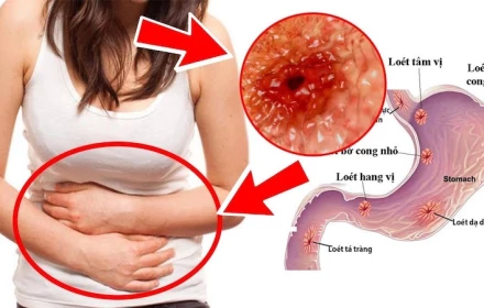 Viêm dạ dày ruột cấp tính là gì và cách phòng tránh trong mùa hè