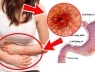 Viêm dạ dày ruột cấp tính là gì và cách phòng tránh trong mùa hè