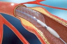 Thách thức stent mỏng nhất thế giới để mở "đường sống" trong mạch máu