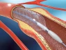 Thách thức stent mỏng nhất thế giới để mở "đường sống" trong mạch máu