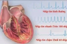 Tại sao rối loạn nhịp tim ngày càng trẻ hóa?