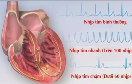 Tại sao rối loạn nhịp tim ngày càng trẻ hóa?