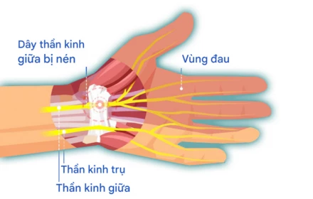 "Bàn tay chuột" là gì và nó phổ biến cỡ nào mà Trung Quốc phải đưa vào danh sách bệnh nghề nghiệp