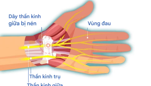 "Bàn tay chuột" là gì và nó phổ biến cỡ nào mà Trung Quốc phải đưa vào danh sách bệnh nghề nghiệp