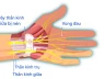 "Bàn tay chuột" là gì và nó phổ biến cỡ nào mà Trung Quốc phải đưa vào danh sách bệnh nghề nghiệp