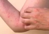 Sốt Chikungunya có để lại di chứng? Ai là nhóm nguy cơ cần đặc biệt chú ý?