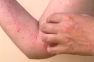 Sốt Chikungunya có để lại di chứng? Ai là nhóm nguy cơ cần đặc biệt chú ý?