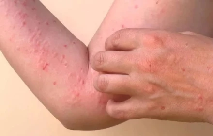Sốt Chikungunya có để lại di chứng? Ai là nhóm nguy cơ cần đặc biệt chú ý?