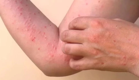 Sốt Chikungunya có để lại di chứng? Ai là nhóm nguy cơ cần đặc biệt chú ý?