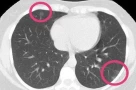 Phát hiện khối u trong phổi qua chụp CT: Đừng vội hoảng, hiểu đúng để không lo lắng sai cách