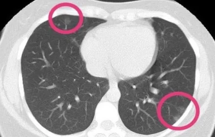 Phát hiện khối u trong phổi qua chụp CT: Đừng vội hoảng, hiểu đúng để không lo lắng sai cách