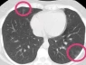Phát hiện khối u trong phổi qua chụp CT: Đừng vội hoảng, hiểu đúng để không lo lắng sai cách