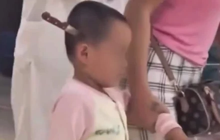 Bé 3 tuổi đi bộ vào bệnh viện với con da o cắm vào đầu