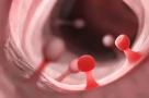 Đừng xem nhẹ polyp và những khối u lành tính trong cơ thể