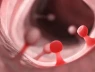Đừng xem nhẹ polyp và những khối u lành tính trong cơ thể