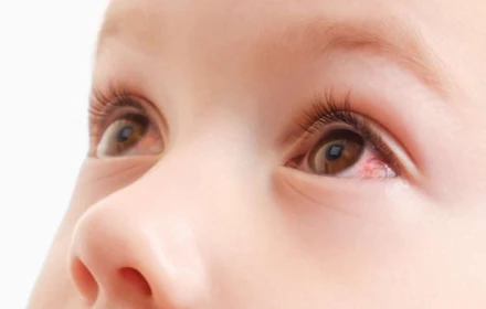 Có đúng là bạn sẽ không bị đau mắt đỏ nữa sau khi đã khỏi bệnh không?