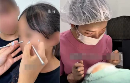 'Dao kéo' cho bé gái 10 tuổi