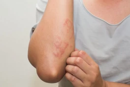 5 dấu hiệu gan nhiễm mỡ dễ nhận thấy