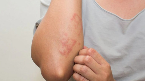 5 dấu hiệu gan nhiễm mỡ dễ nhận thấy