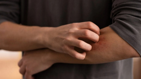 Gãi ngứa: Vừa hại vừa lợi? Nghiên cứu mới hé lộ sự thật bất ngờ về vòng luẩn quẩn ngứa-gãi