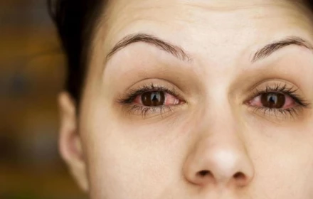 Triệu chứng của thận yếu biểu hiện ở mắt