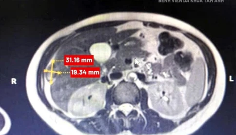 Người phụ nữ có thai làm tổ trong bao gan