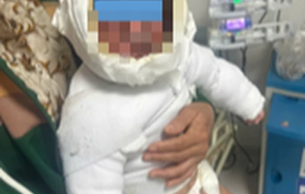 Bé trai 9 tháng tuổi bị bỏng 30% cơ thể do kéo dây điện ấm siêu tốc