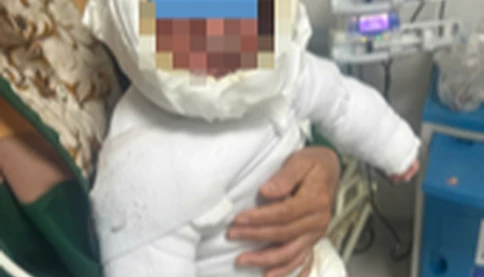 Bé trai 9 tháng tuổi bị bỏng 30% cơ thể do kéo dây điện ấm siêu tốc