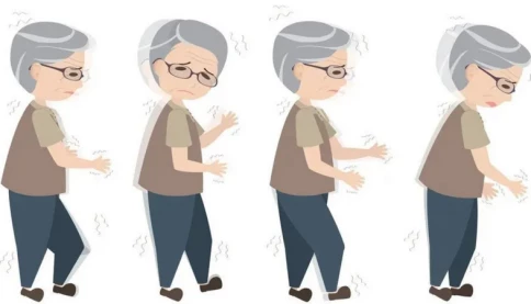 5 lầm tưởng phổ biến về bệnh Parkinson
