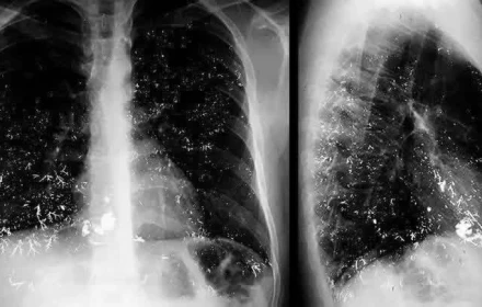 Tắm nước nóng sau khi nhiệt kế vỡ: Hành động khiến chàng trai 19 tuổi nhập viện