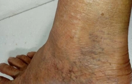 KÍCH HOẠT TUẦN HOÀN MÁU CHÂN