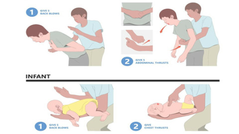 Cảnh báo: Vỡ dạ dày vì thực hiện thủ thuật Heimlich sai cách