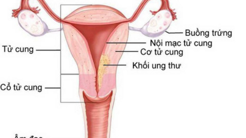 Ung thư nội mạc tử cung và vai trò của siêu âm