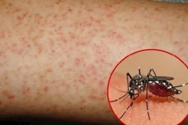 Loại thuốc tuyệt đối không dùng khi bị sốt xuất huyết