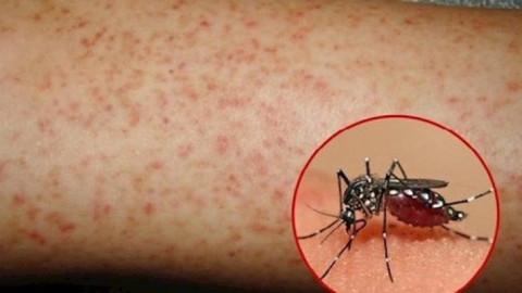 Loại thuốc tuyệt đối không dùng khi bị sốt xuất huyết
