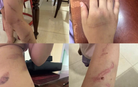 Phát hiện con gái 9 tuổi có 34 vết bầm, bố tố lên công an