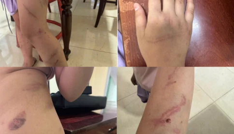 Phát hiện con gái 9 tuổi có 34 vết bầm, bố tố lên công an