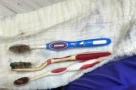 Gắp được 3 bàn chải ra khỏi đường tiêu hóa một bệnh nhân