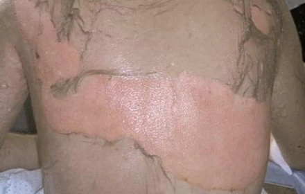 Ăn lẩu xong nổi ban, người phụ nữ nhập viện trong tình trạng “lột da toàn thân” vì sai lầm quen thuộc