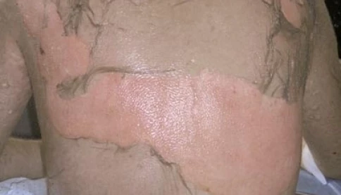 Ăn lẩu xong nổi ban, người phụ nữ nhập viện trong tình trạng “lột da toàn thân” vì sai lầm quen thuộc