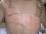 Ăn lẩu xong nổi ban, người phụ nữ nhập viện trong tình trạng “lột da toàn thân” vì sai lầm quen thuộc
