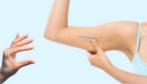 Tại sao một số chị em cấy que tránh thai xong tăng cân thấy rõ?