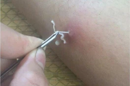 Cảnh báo: Một loạt ký sinh trung nguy hiểm vừa tái xuất ở Việt Nam, tấn công nhiều nam giới