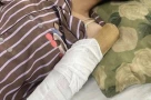 Chồng cô gái bị cuốn vào máy ép nước mía xin dừng nhận hỗ trợ sau khi đủ viện phí