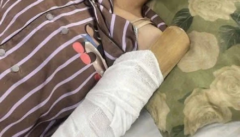 Chồng cô gái bị cuốn vào máy ép nước mía xin dừng nhận hỗ trợ sau khi đủ viện phí