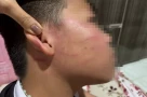 Xác minh vụ học sinh lớp 4 nghi bị giáo viên dạy thêm đánh bầm tím vùng mặt