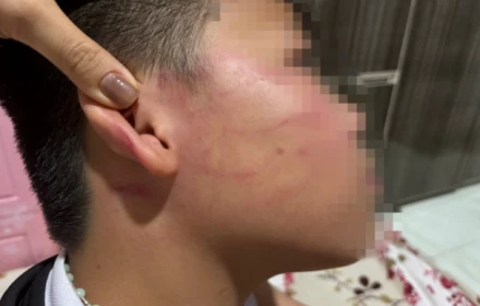 Xác minh vụ học sinh lớp 4 nghi bị giáo viên dạy thêm đánh bầm tím vùng mặt