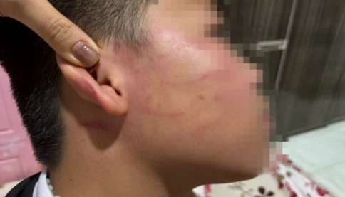Xác minh vụ học sinh lớp 4 nghi bị giáo viên dạy thêm đánh bầm tím vùng mặt