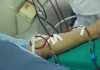 Người trẻ ngày càng mắc suy thận: Bác sĩ cảnh báo 3 dấu hiệu sớm dễ bị bỏ qua