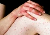 Người bị viêm da cơ địa cần lưu ý gì để tránh bùng phát trong những ngày nắng nóng?